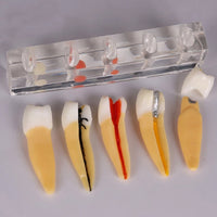 Modelo Dental de 5 etapas para tratamiento endodontico