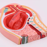 Modelo de desprendimiento separacion de placenta