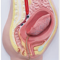 Modelo de desprendimiento separacion de placenta