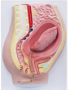 Modelo de desprendimiento separacion de placenta