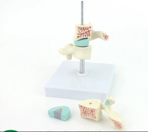 Anatomia osteoporosis intra-vertebral.