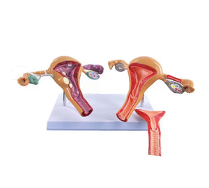 Modelo Utero Sano VS Patologías