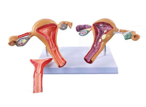 Modelo Utero Sano VS Patologías