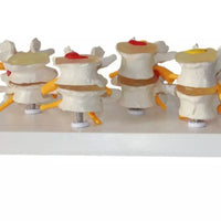 Modelo anatómico degeneracion lumbar vertebras