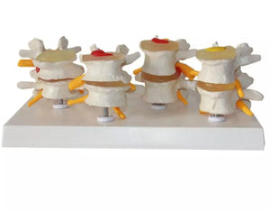 Modelo anatómico degeneracion lumbar vertebras