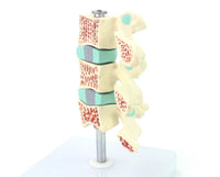 Anatomia osteoporosis intra-vertebral.
