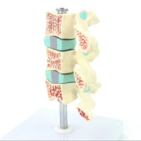 Anatomia osteoporosis intra-vertebral.