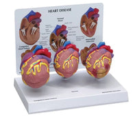 Modelo corazon comparativo sano y enfermo con infarto microcardio vs insuficiencia cardiaca
