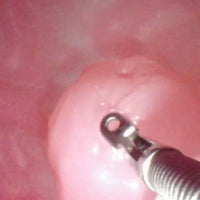Simulador duodenal endoscopia estomago duodeno gastro