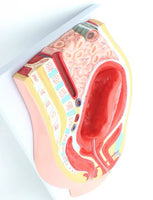 Modelo de desprendimiento separacion de placenta
