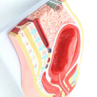 Modelo de desprendimiento separacion de placenta