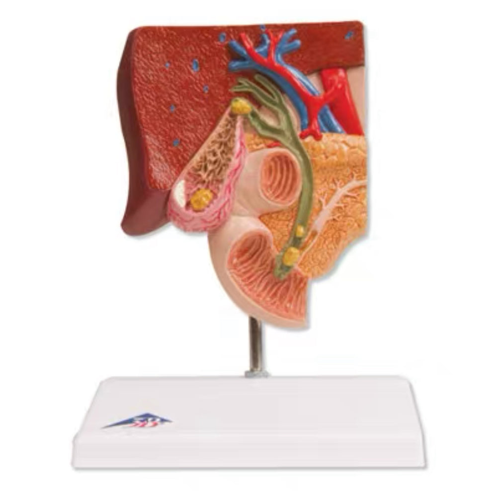 Modelo de cálculos biliares - Alta Simulacion