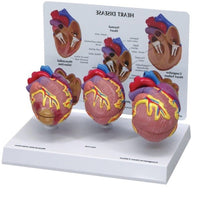 Modelo corazon comparativo sano y enfermo con infarto microcardio vs insuficiencia cardiaca