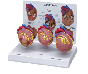 Modelo corazon comparativo sano y enfermo con infarto microcardio vs insuficiencia cardiaca