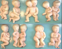 Set desarrollo fetal - Deformaciones embarazo gemelos
