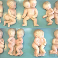 Set desarrollo fetal - Deformaciones embarazo gemelos