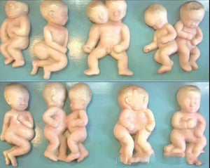 Set desarrollo fetal - Deformaciones embarazo gemelos