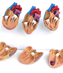 Modelo corazon comparativo sano y enfermo con infarto microcardio vs insuficiencia cardiaca