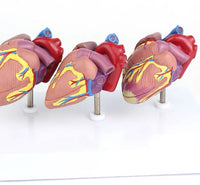 Modelo corazon comparativo sano y enfermo con infarto microcardio vs insuficiencia cardiaca
