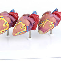 Modelo corazon comparativo sano y enfermo con infarto microcardio vs insuficiencia cardiaca