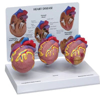 Modelo corazon comparativo sano y enfermo con infarto microcardio vs insuficiencia cardiaca