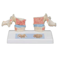 Modelo de osteoporosis de la columna vertebral humana - Alta Simulacion