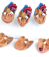 Modelo corazon comparativo sano y enfermo con infarto microcardio vs insuficiencia cardiaca
