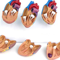 Modelo corazon comparativo sano y enfermo con infarto microcardio vs insuficiencia cardiaca