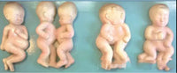 Set desarrollo fetal - Deformaciones embarazo gemelos
