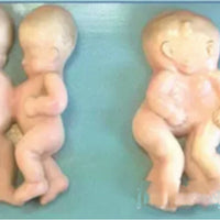 Set desarrollo fetal - Deformaciones embarazo gemelos