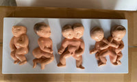 Set desarrollo fetal - Deformaciones embarazo gemelos
