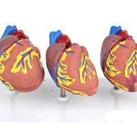 Modelo corazon comparativo sano y enfermo con infarto microcardio vs insuficiencia cardiaca