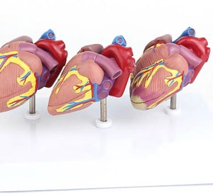 Modelo corazon comparativo sano y enfermo con infarto microcardio vs insuficiencia cardiaca