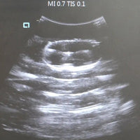 Simulador ultrasonido guiado punsion renal - biopsia
