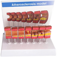 Modelo de anatomía de la arteria humana aterosclerosis
