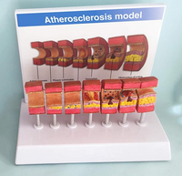 Modelo de anatomía de la arteria humana aterosclerosis
