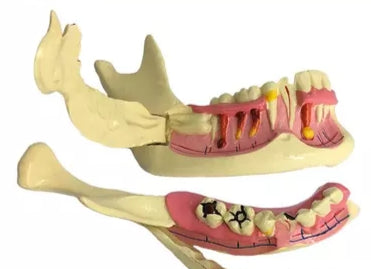 Modelo de descomposicion dental (mandibula derecha)