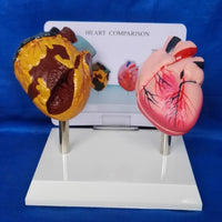 Modelo anatomico comparativo corazon de fumador