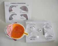 Modelo Optico Cataratas anatomia (cornea)
