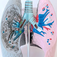 Modelo anatomico comparativo pulmon de fumador
