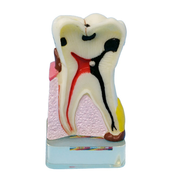 Modelo anatomíco- patología dientes humanos