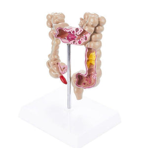 Modelo de colon Patologias