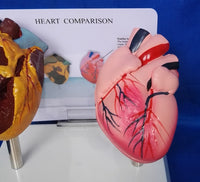 Modelo anatomico comparativo corazon de fumador
