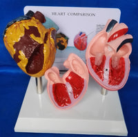 Modelo anatomico comparativo corazon de fumador
