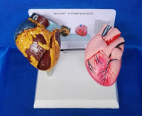 Modelo anatomico comparativo corazon de fumador
