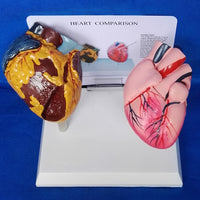 Modelo anatomico comparativo corazon de fumador