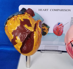 Modelo anatomico comparativo corazon de fumador