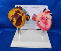 Modelo anatomico comparativo corazon de fumador
