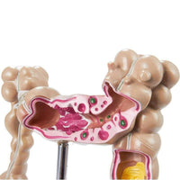 Modelo Anatomico intestino grueso (Patologias)
