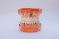 Modelo de implantes dentales

